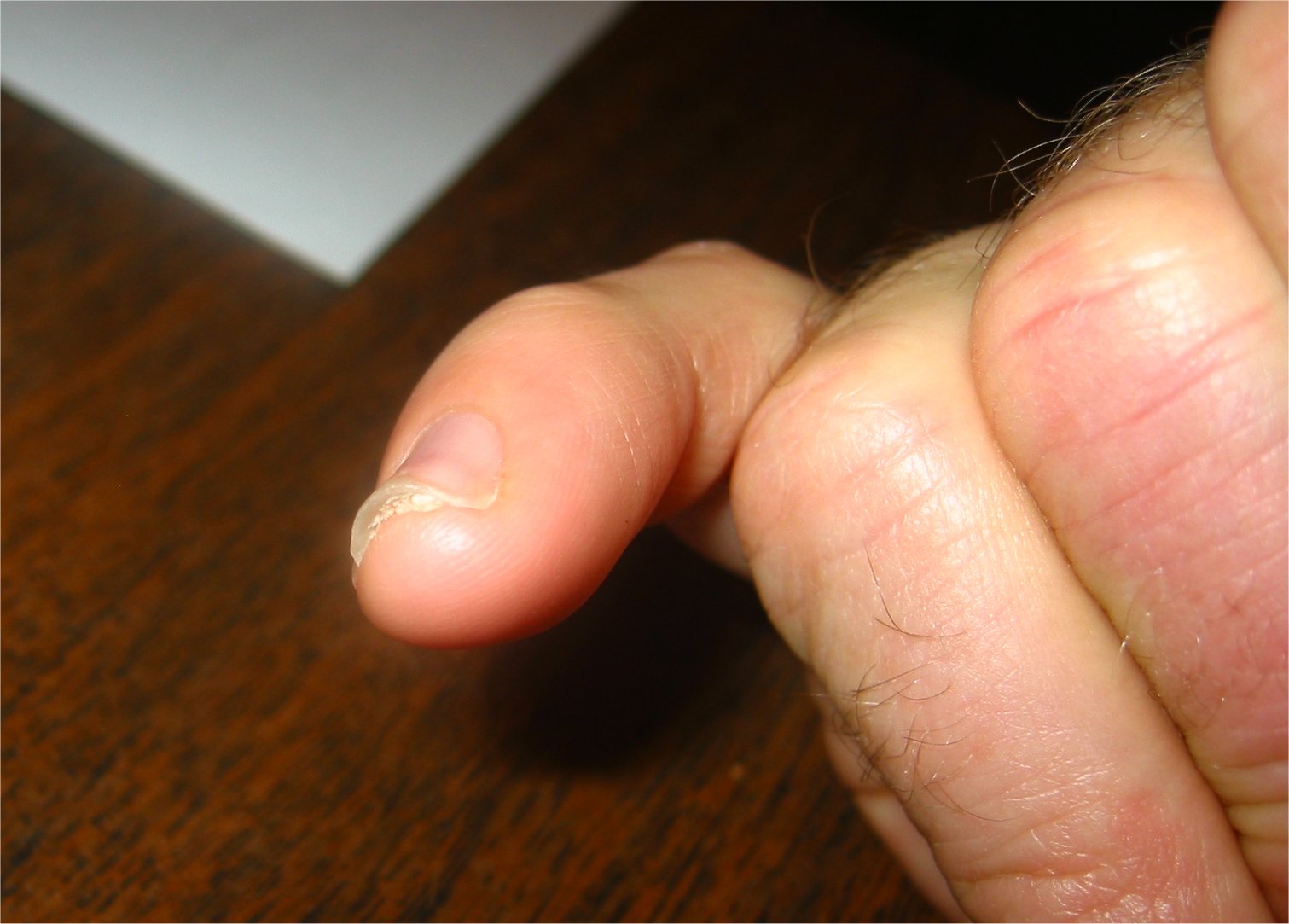 Blackened Fingernail Smashed